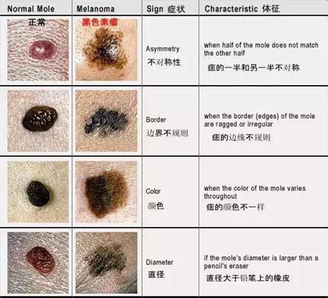 黑痔|痣是什麼？會變成黑色素瘤？7種一定要除的痣